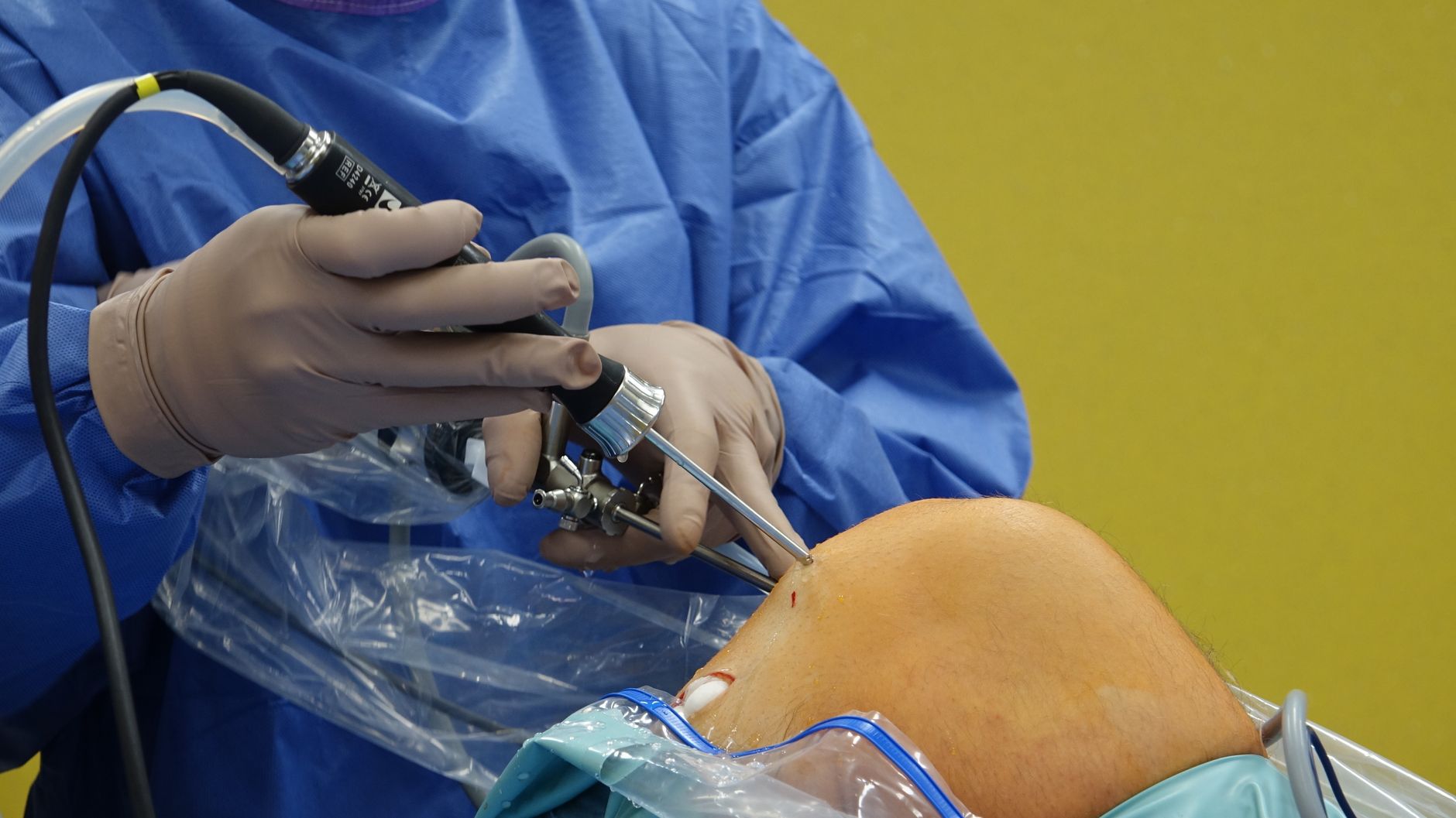 Dokter bedah menggunakan artroskop untuk operasi lutut yang presisi di ruang operasi.